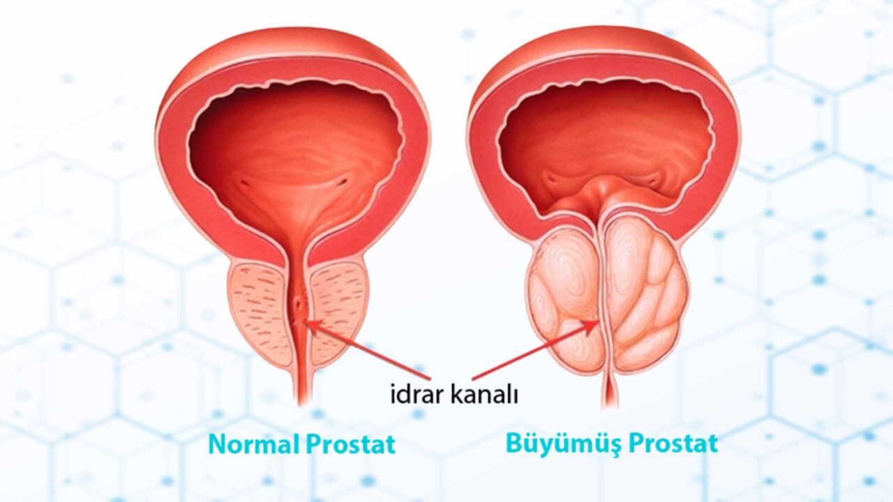 https://www.drmurattuncer.com/wp-content/uploads/2024/09/iyi-huylu-prostat-1280x720.jpg